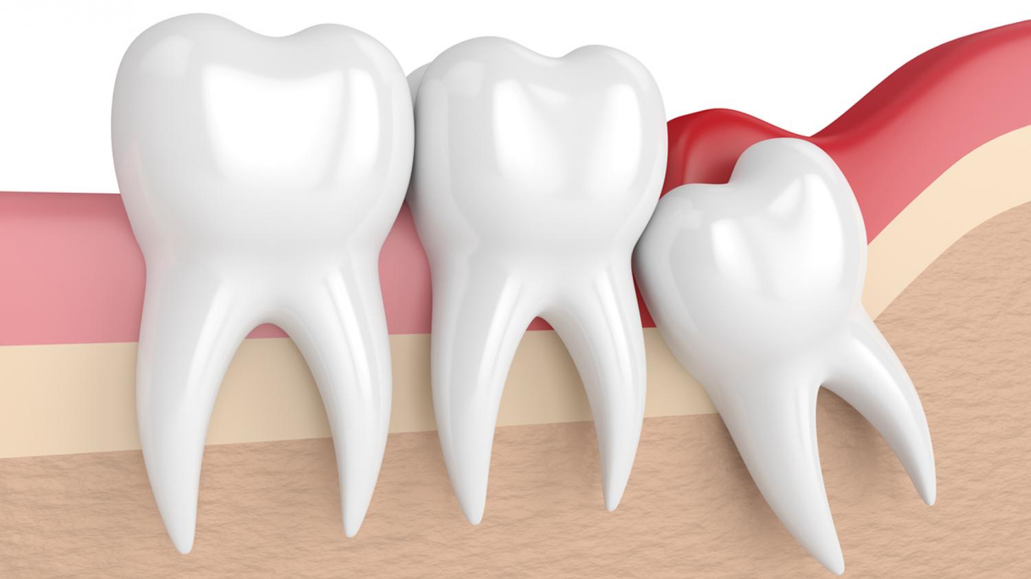Дистопированный зуб — значение, лечение и профилактика