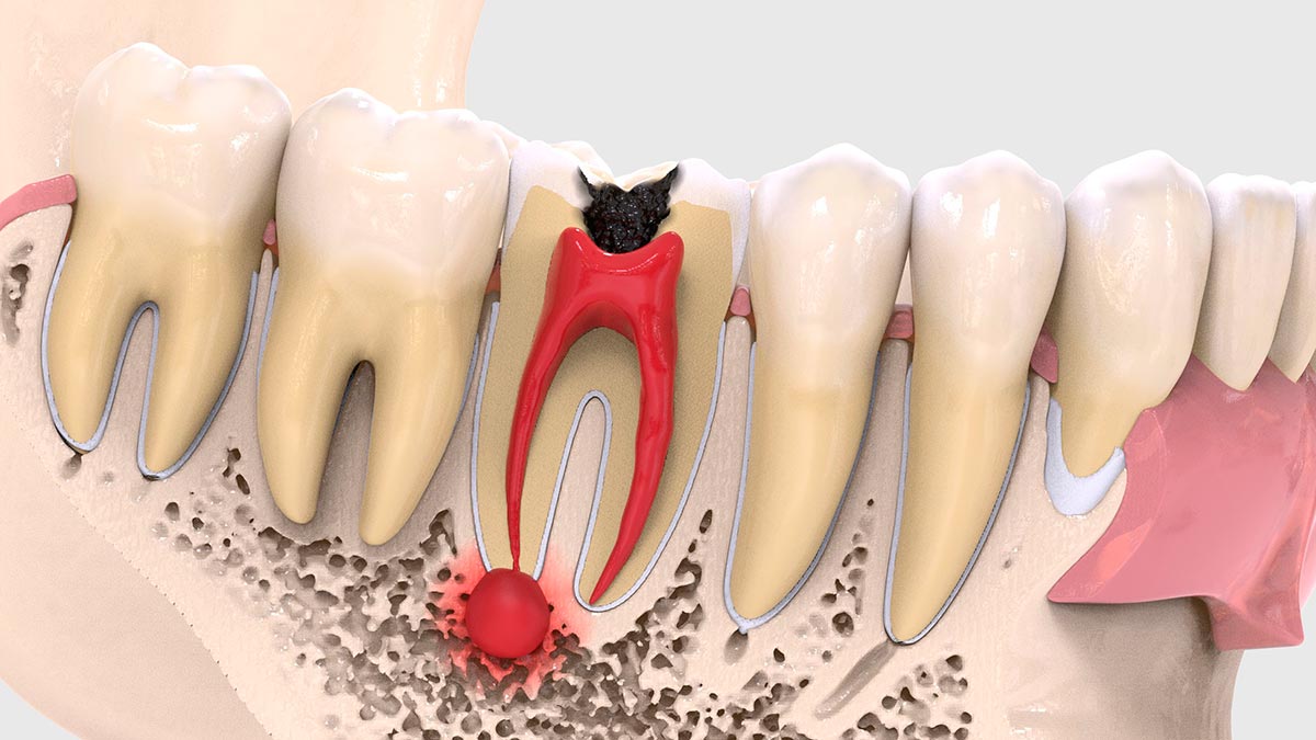 Гранулема зуба — причины образования, методы лечения