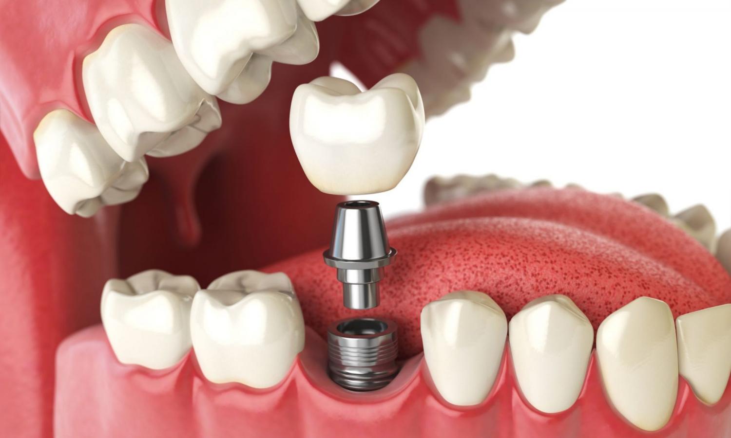 Этапы установки и сроки имплантации зубов